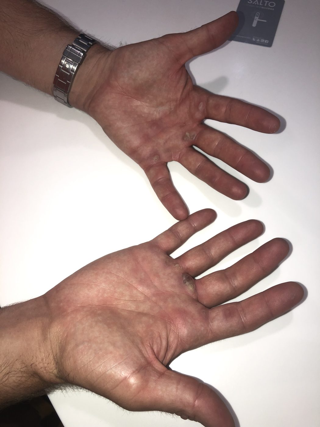 Blisters on blisters